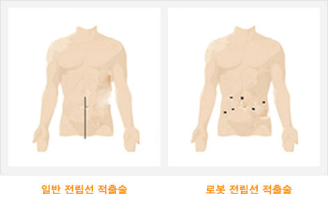 일반 전립선 적출술과 로봇 전립선적출술의 절개부위 비교