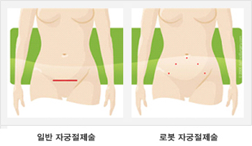 개복 자궁절제술과 로봇 자궁절제술의 절개부위 비교