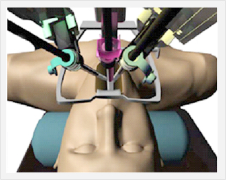 입안으로 로봇내시경과 수술도구를 넣은 그림